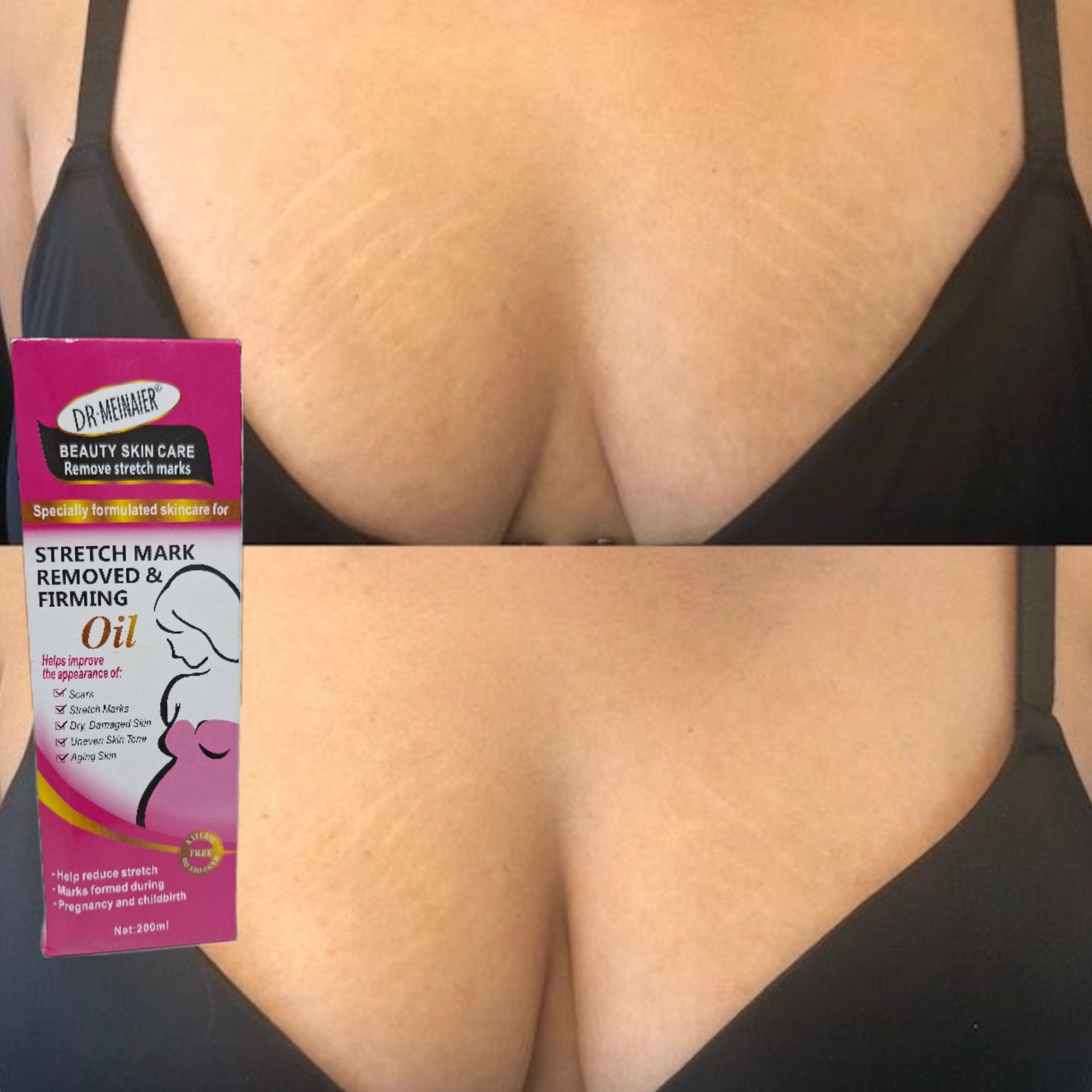 Stretchmark removed & firming oil